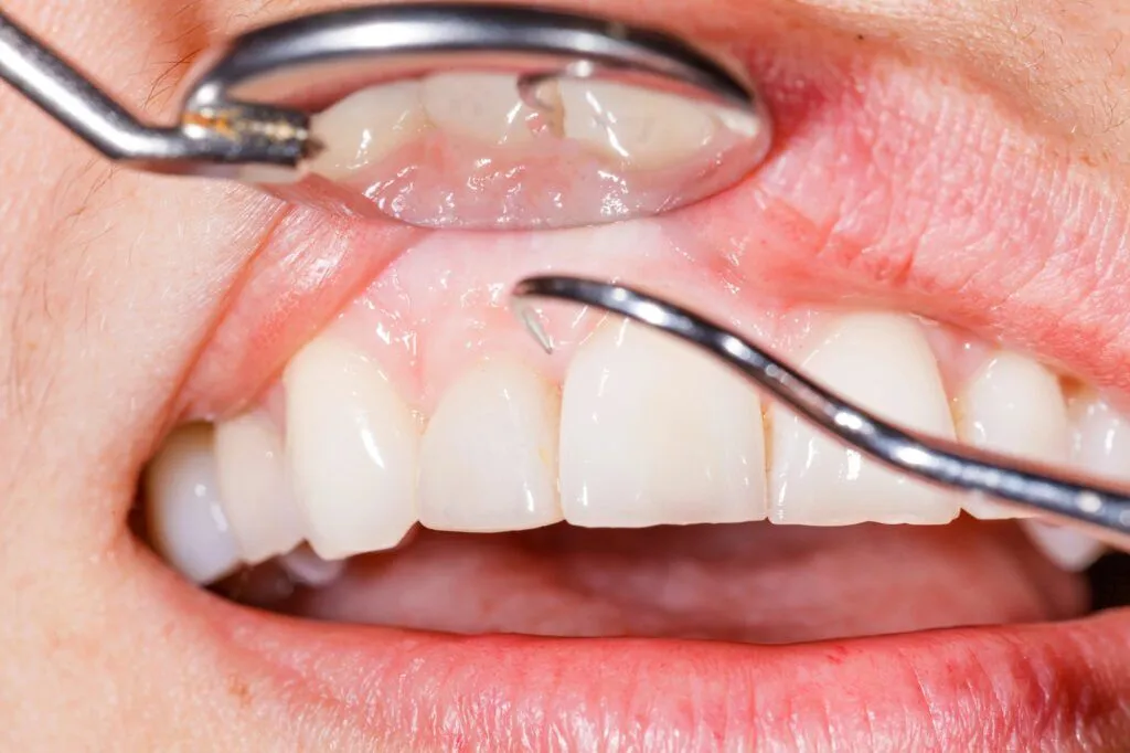 tobacco pouches in mouth 4 Ways Nicotine Pouches Can Impact Your Oral Health
