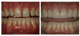Three Things You Must Know About Dental Implants Bismarck Advanced Dental ND