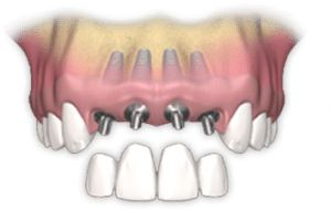 Multi-tooth Implants Bismarck Advanced Dental ND