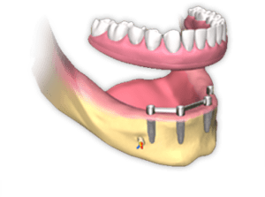 Dentures or Dental Implants?