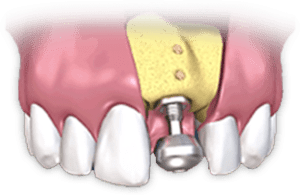 Three Things You Must Know About Dental Implants