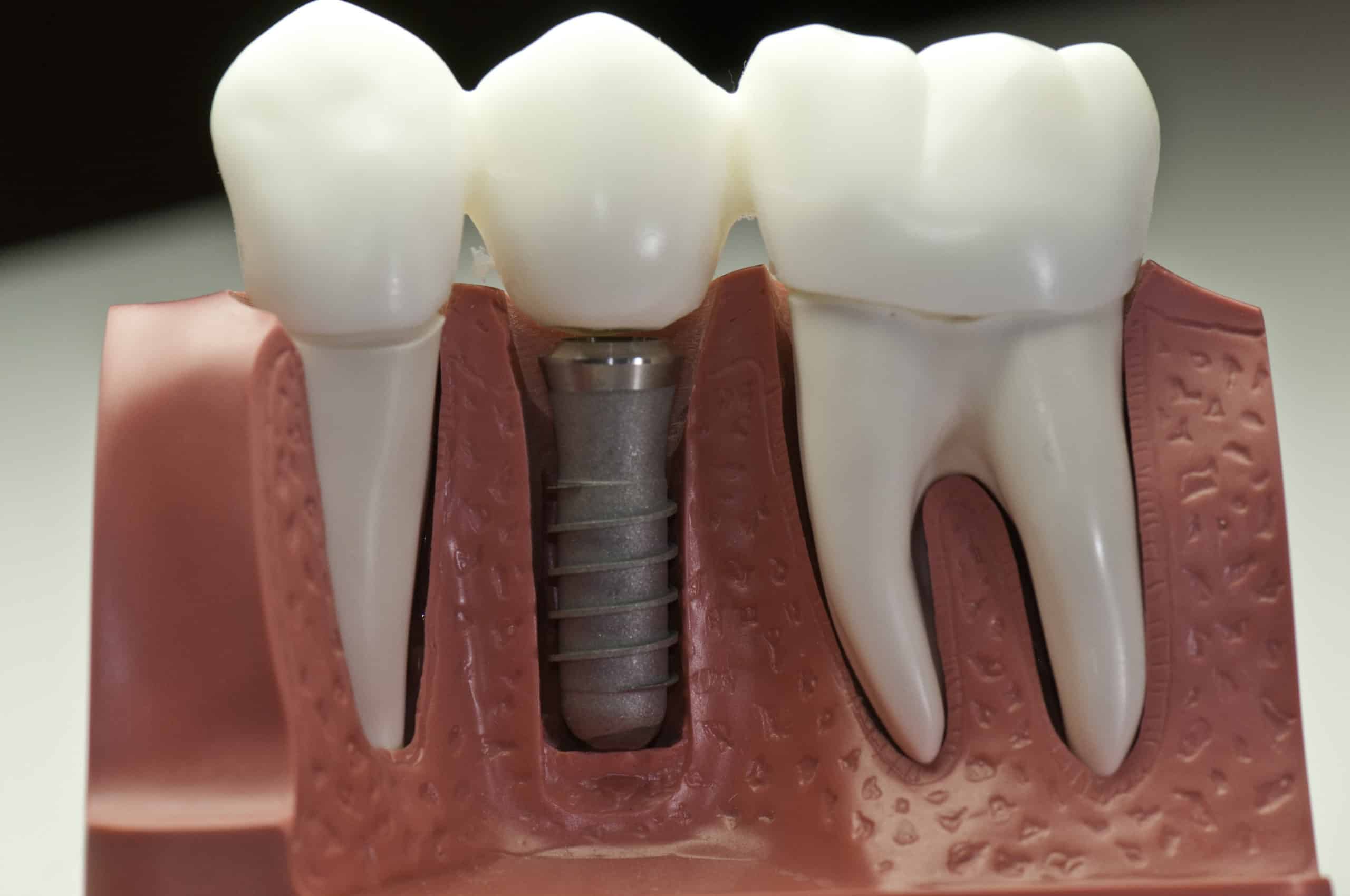 Options For Replacing Teeth Bismarck Dental and Implants North Dakota