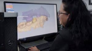 Sinus Augmentation Sinus Augmentation Bismarck Advanced Dental and Implants ND