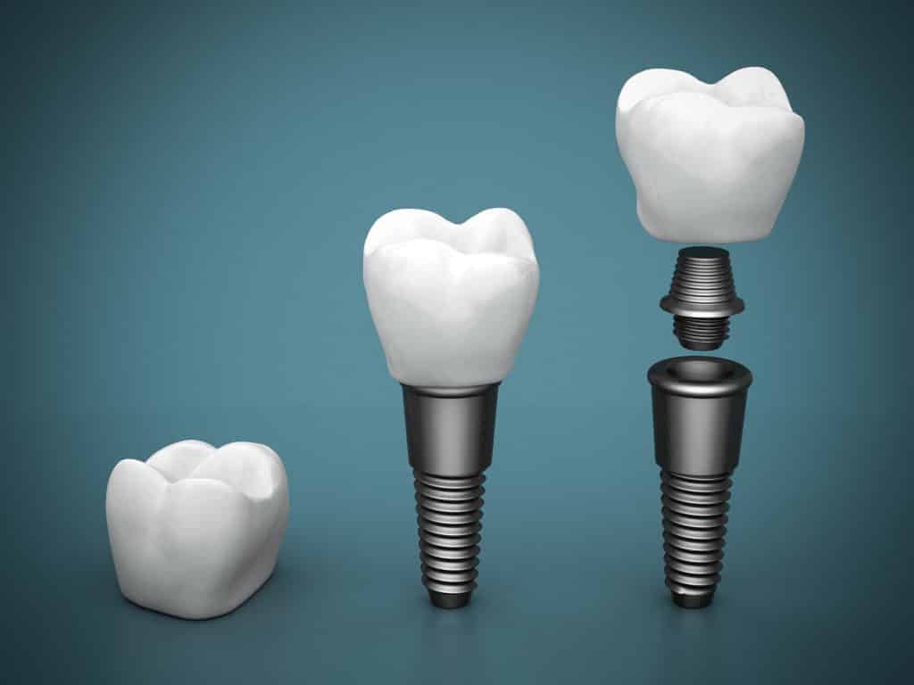 What Makes You A good Candidate For Dental Implants