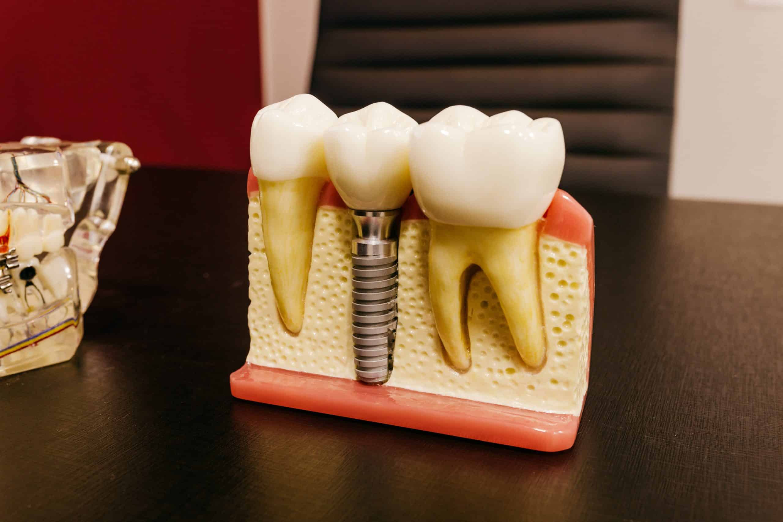 How To Care For Your Dental Implants dental implant model