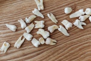 Tooth loss, teeth on table, dentist 