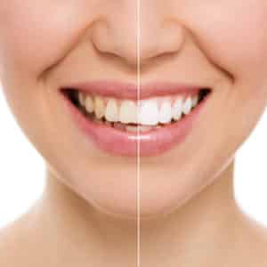 teeth whitening north dakota bismarck advanced dental and implants