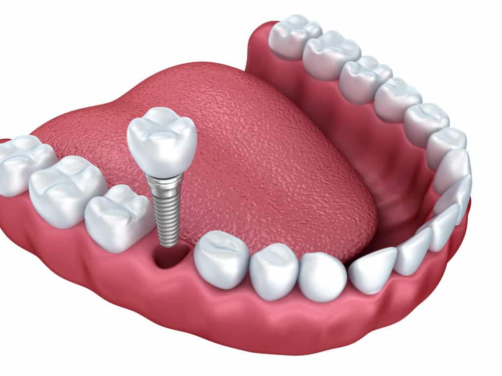 good candidate for dental implants