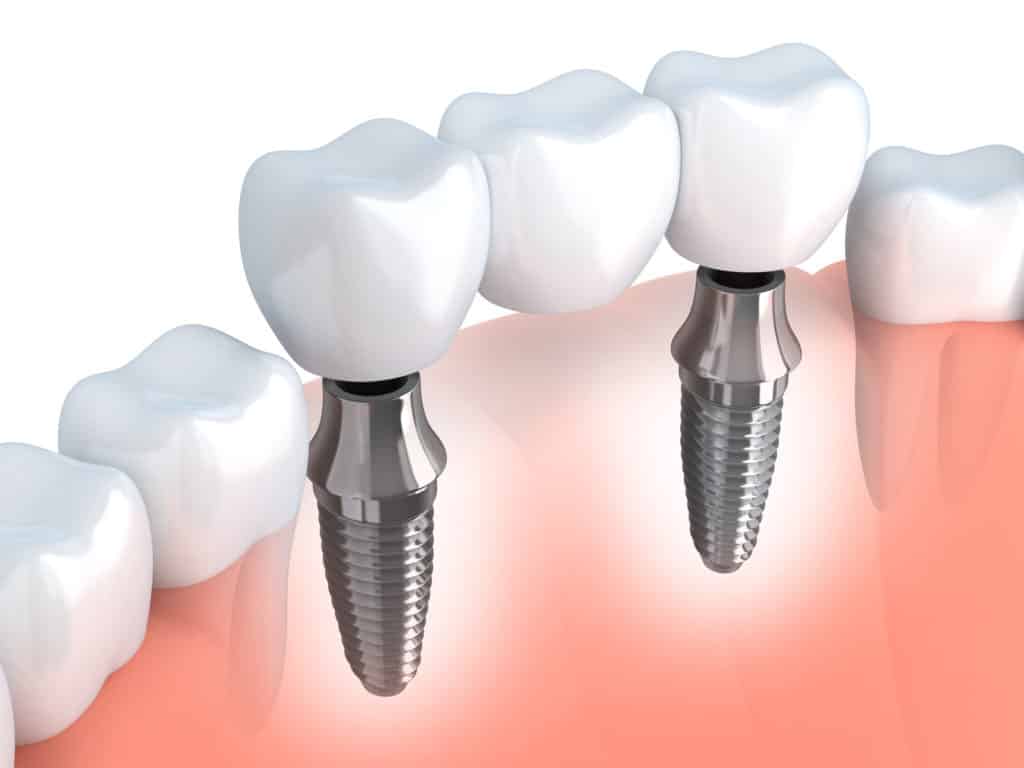 different types of dental implants
