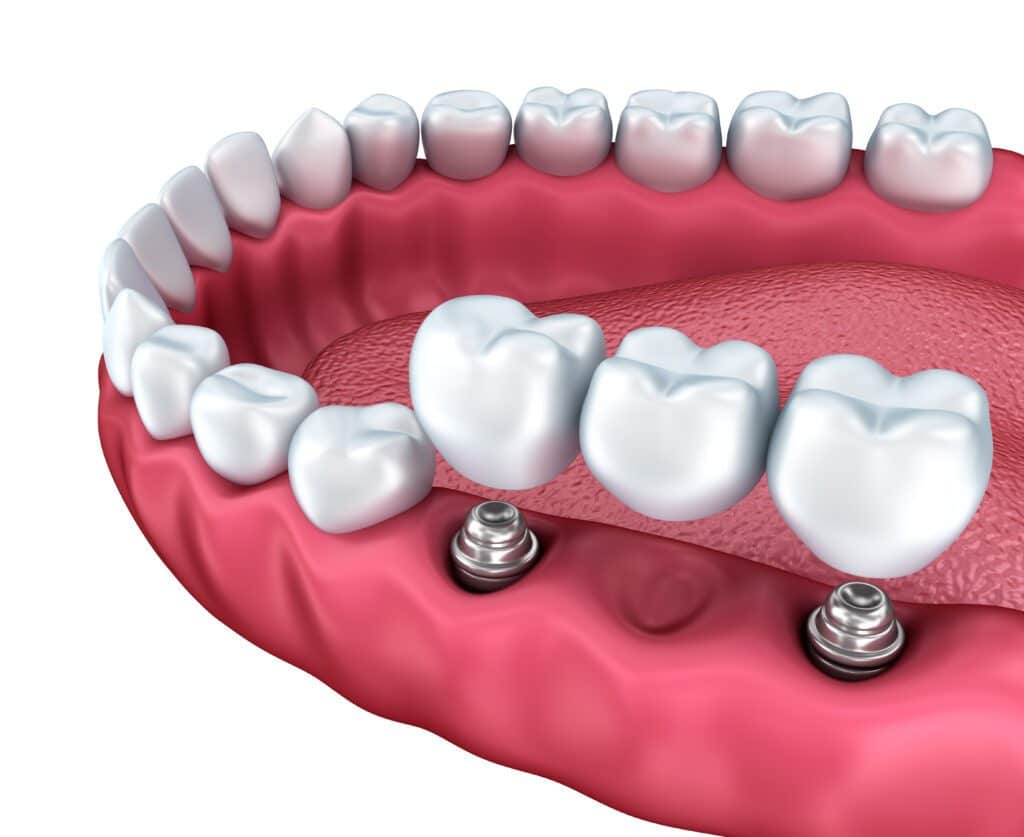 Types of dental implants in Bismarck, ND