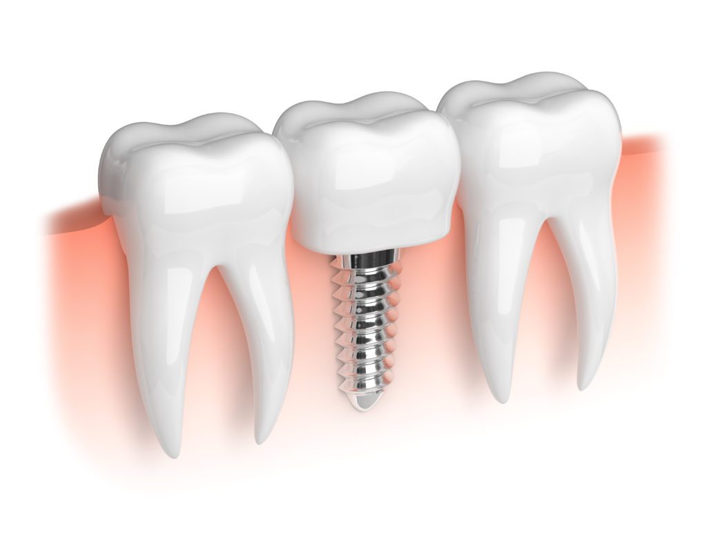 drawbacks of getting dental implants
