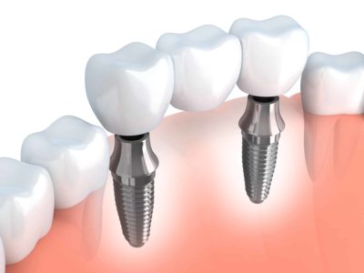 Dental implants can change your life