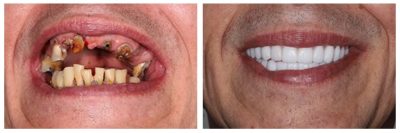 7 Ways Dental Implants Can Change Your Life Dental Implants