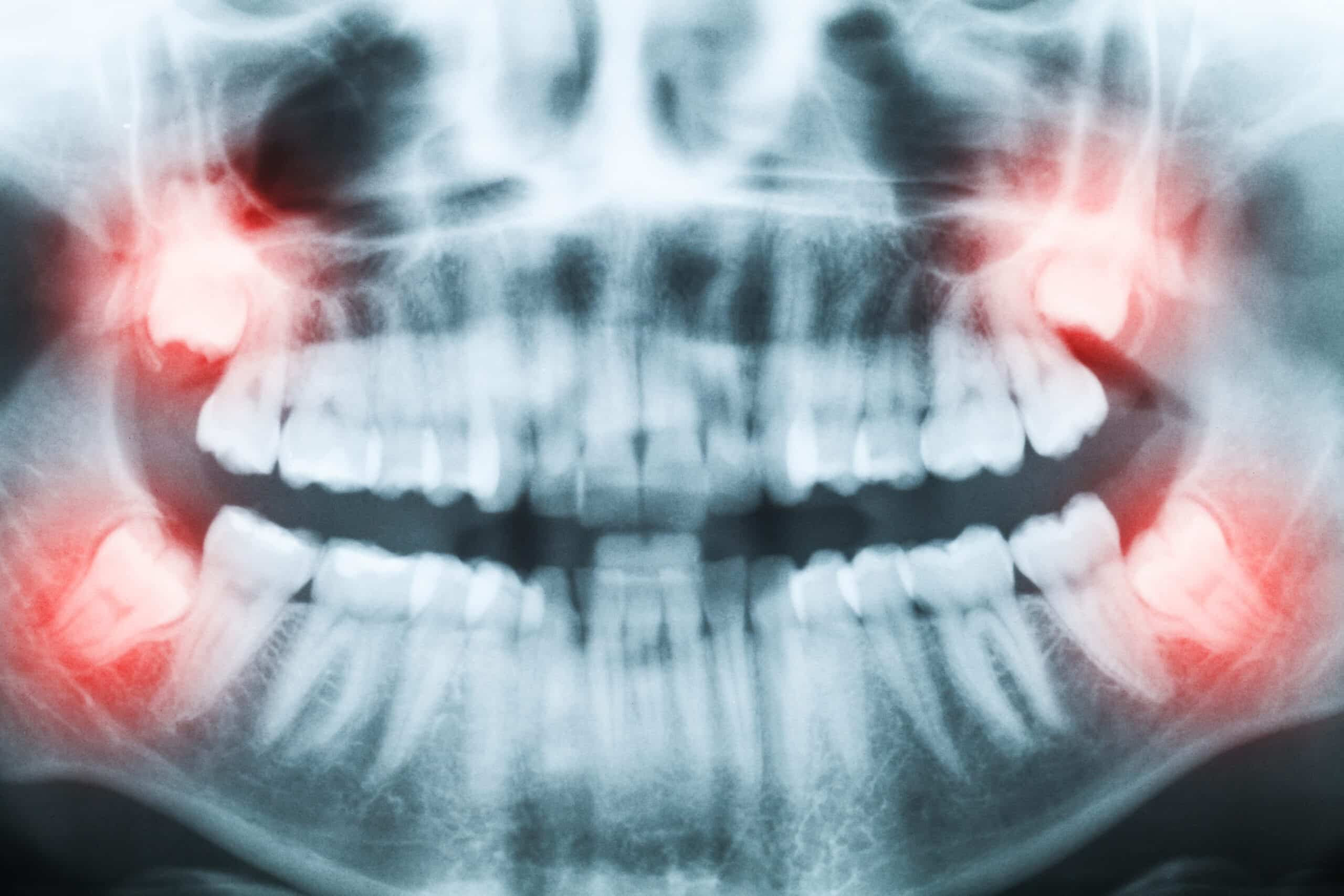 Everything You Should Know About Wisdom Teeth Removal Wisdom Teeth Removal