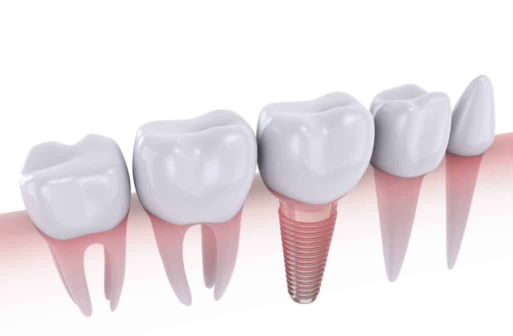 Understanding the Ins and Outs of Single Tooth Implants