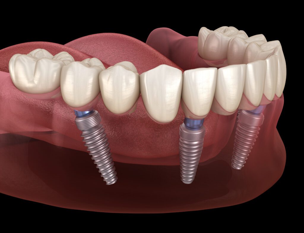 Mandibular prosthesis All on 4 system supported by implants. Medically accurate 3D illustration of human teeth and dentures concept. All-on-4 Dental Implants