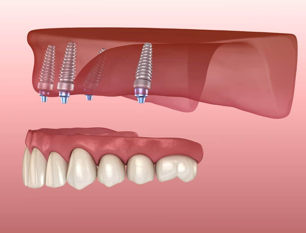 Maxillary prosthesis with gum All on 4 system supported by implants. Medically accurate 3D illustration of human teeth and dentures. All-on-4 Dental Implants