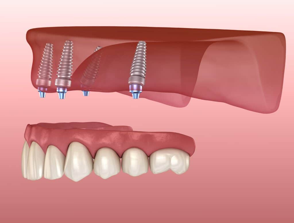 All on 4 Dental Implants vs. Full Mouth Restorations Maxillary prosthesis with gum All on 4 system supported by implants. Medically accurate 3D illustration of human teeth and dentures. All-on-4 Dental Implants