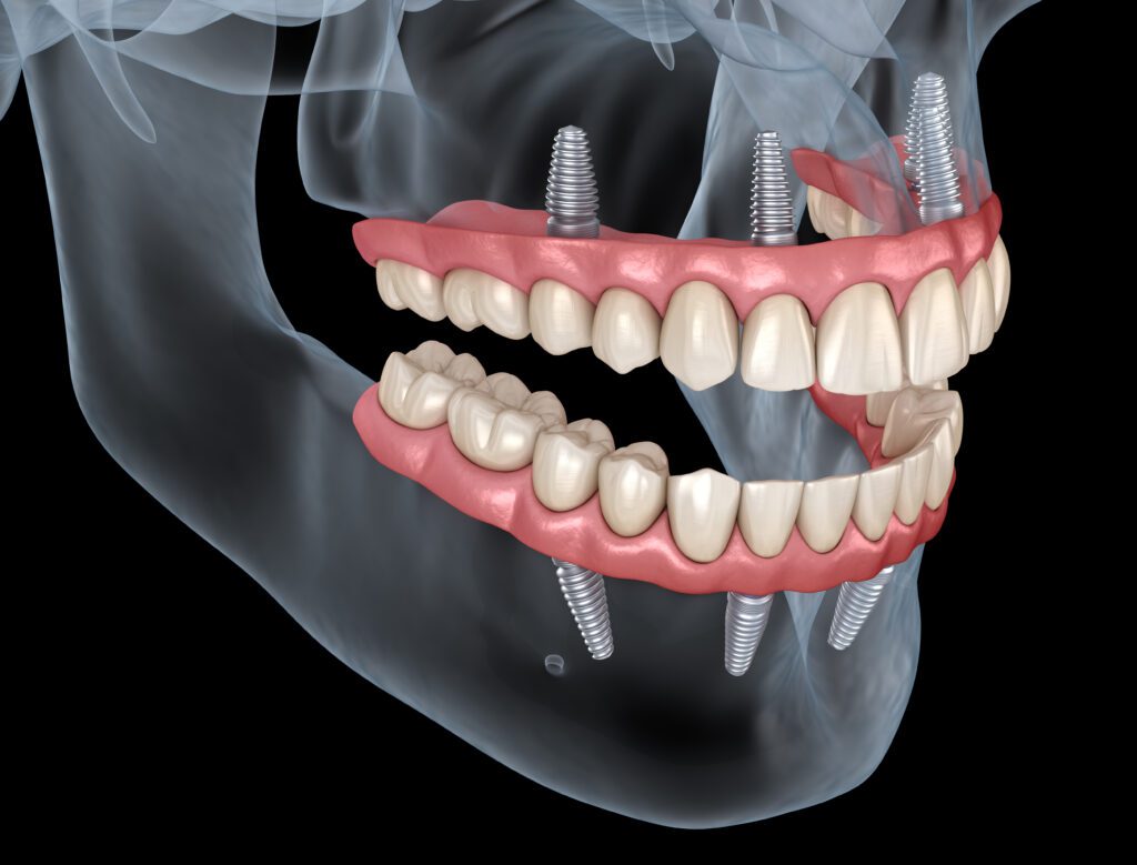 Maxillary and Mandibular prosthesis with gum All on 4 system supported by implants. Medically accurate 3D illustration of human teeth and dentures. All-on-4 Dental Implants