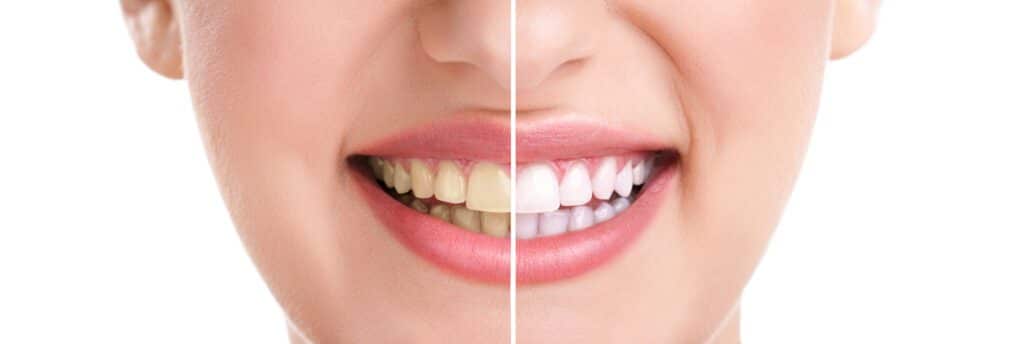 woman teeth and smile, close up, isolated on white, whitening treatment. Are Teeth Naturally White or Yellow?