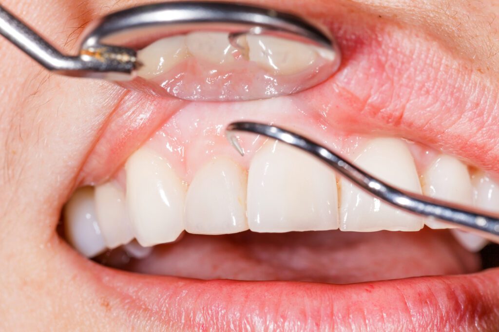 5 Possible Reasons Why Gums Bleed When You Floss 5 Possible Reasons Why Gums Bleed When You Floss
