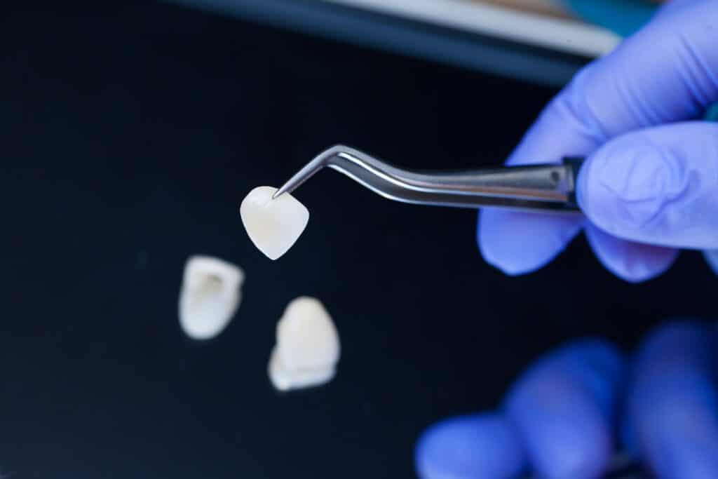 Protecting Your Veneers: 5 Ways To Care For This Major Dental Investment Protecting your veneers in Bismarck, North Dakota