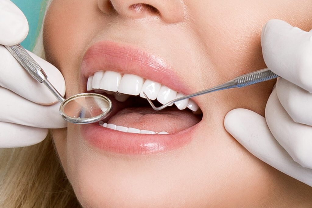 Protecting Your Veneers: 5 Ways To Care For This Major Dental Investment Protecting your veneers in Bismarck, North Dakota