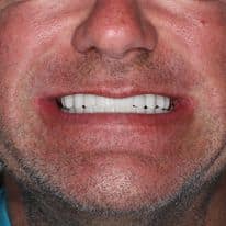 all on four dental implants