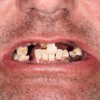 north dakota all on four dental implants before