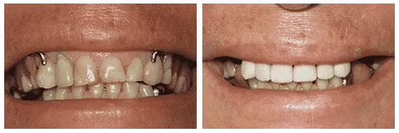 Multi-Tooth Implants Multi-Tooth Implants Bismarck Advanced Dental and Implants - ND