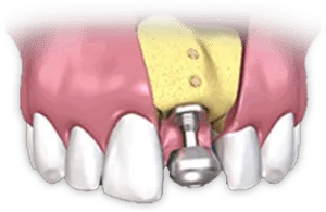 Multi-Tooth Implants Multi-Tooth Implants Bismarck Advanced Dental and Implants - ND