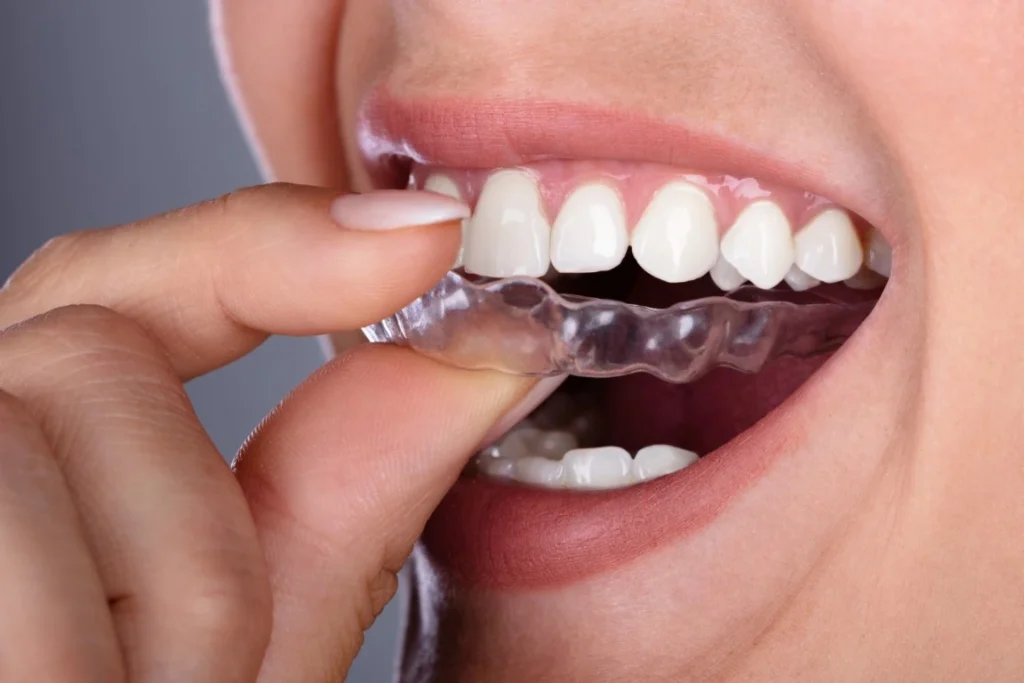 Can You Get Invisalign With Missing Teeth? Missing Teeth - Bismarck, ND