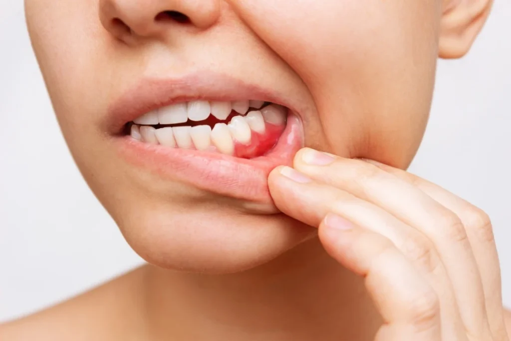 Why You Need To Treat Periodontal Disease Before Getting Dental Implants Periodontal Disease - Bismarck, ND