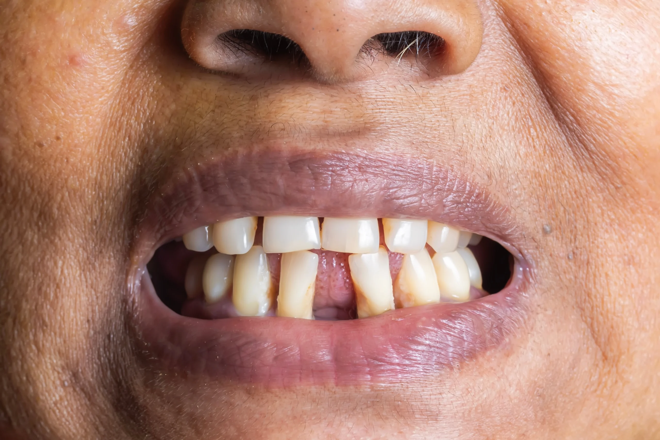 The Psychological Impact Of Dental Implants For Missing Front Teeth Missing Front Teeth - Bismarck, ND