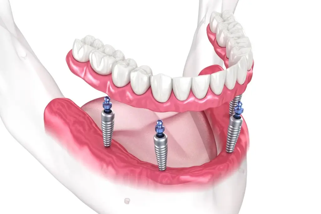 Full-Arch Replacement - Bismarck, ND